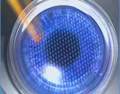 Femto-LASIK: Der Femtosekundenlaser schneidet den Hornhaut-Flap