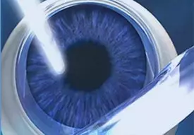 Femto-LASIK: Der Excimer Laser verdampft Hornhautgewebe und korrigiert so die bestehende Fehlsichtigkeit