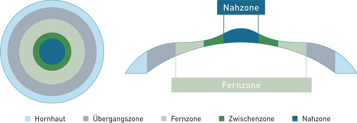 Schematische Darstellung des Hornhautabtrags bei PresbyMAX