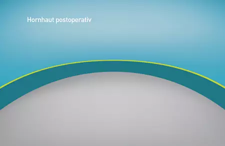 SmartSurf:  Die oberste Hornhautschicht wächst wieder zu.