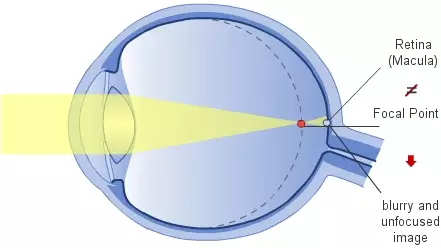 The nearsighted eye