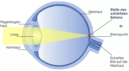 Normalsichtiges Auge: Der Brennpunkt liegt auf der Netzhaut
