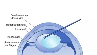 Linsenimplantation: Die Kunstlinse wird im Kapselsack fixiert 